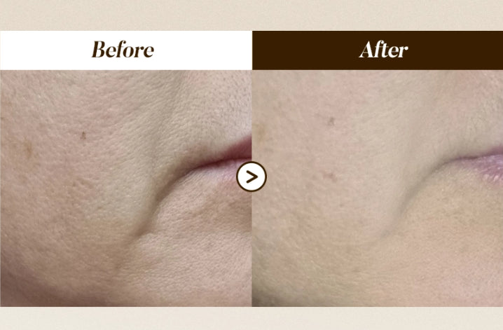 JEU'DEMEURE DermiShuttle Lifting Kit